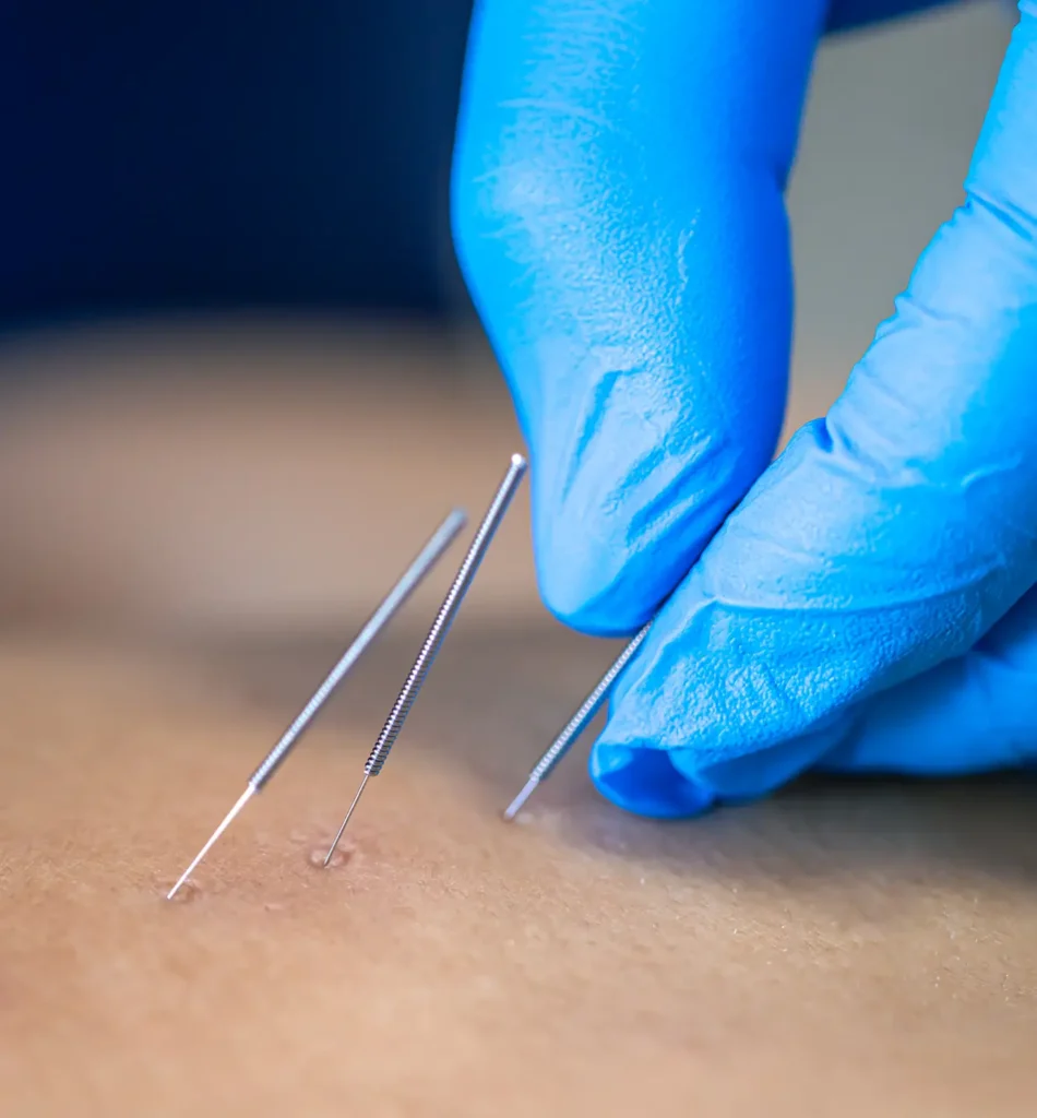 Medical Acupuncture